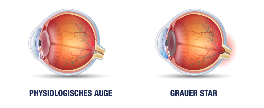 Links ein gesundes Auge und rechts ein Auge mit grauem Star. 