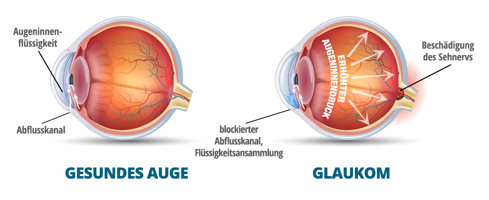 Glaukom = Grüner Star