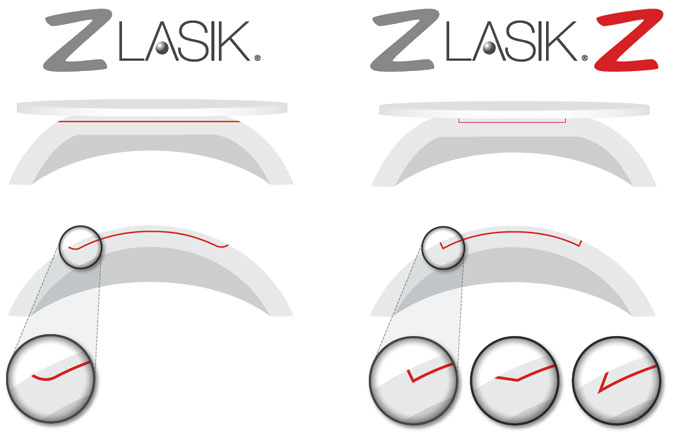 Vorteile der Operation Z-LASIK Z 3D mit dem Femtosekundenlaser FEMTO LDV Z8